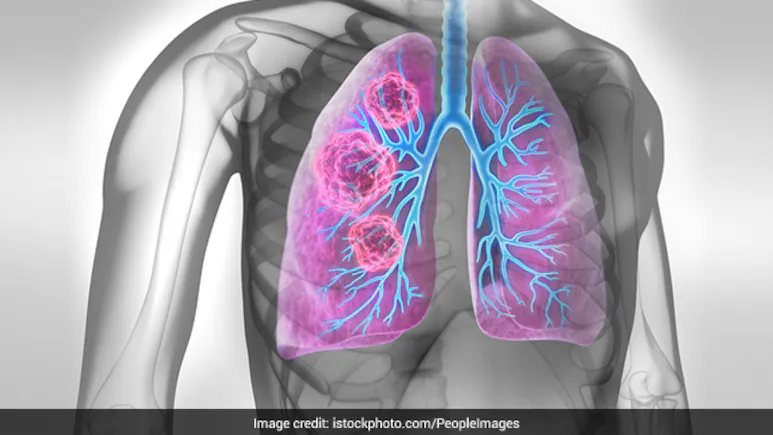 lung cancer